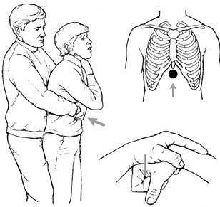 Maniobra de Heimlich