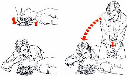 Reanimación cardiopulmonar