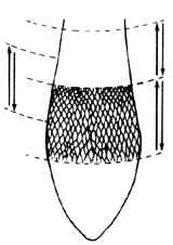 En el dibujo, se indican esquemáticamente los distintos lugares, alrededor del pie, donde puede presentarse la franja rojo-rosada.