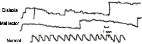 Los movimientos oculares durante la lectura. Los movimientos de arriba abajo del registro se corresponden con la izquierda y derecha