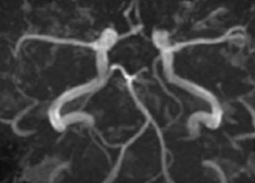 Imágenes de vasos sanguíneos en el cerebro. Los cambios en el flujo sanguíneo se pueden medir y sirven como índice de actividad neuronal.