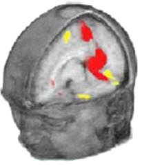 Con la nueva tecnología informática, las imágenes obtenidas por scanners PET y MRI muestran donde exactamente ocurren los cambios en flujo sanguíneo dentro del cerebro